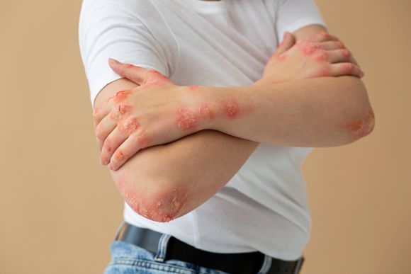 Mối liên hệ giữa bệnh vảy nến và viêm khớp dạng thấp