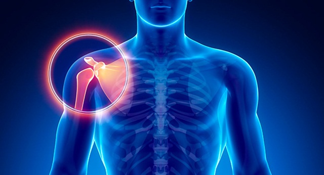 5 loại viêm khớp thường xảy ra ở vai
