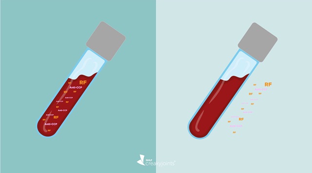 Viêm khớp dạng thấp huyết thanh âm tính là gì?