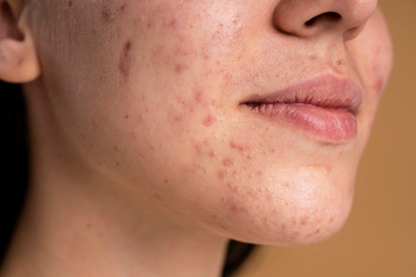 Mối liên hệ giữa viêm khớp dạng thấp và mụn trứng cá