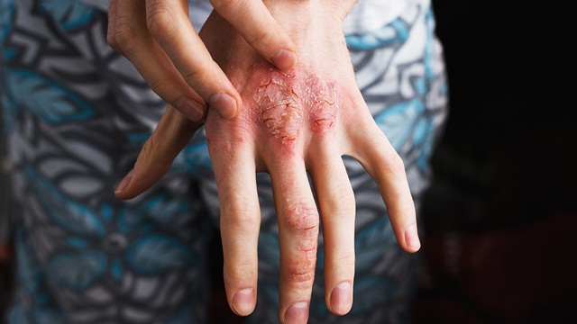 Điểm giống và khác nhau giữa viêm khớp vảy nến và viêm khớp dạng thấp