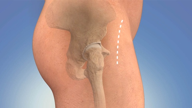 Thay khớp háng qua đường mổ trước: Ưu điểm và rủi ro