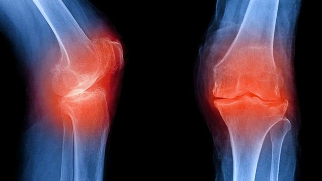 Các cách giảm đau do thoái hóa khớp