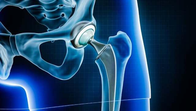 Ưu và nhược điểm của khớp háng nhân tạo bằng gốm