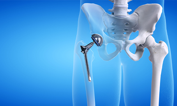 Những điều cần biết về phẫu thuật thay khớp háng toàn phần