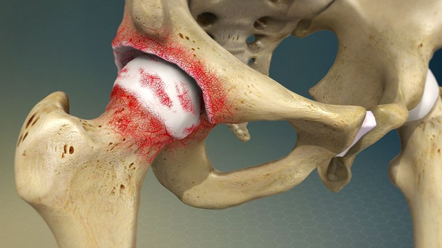 Các phương pháp điều trị thoái hóa khớp hông