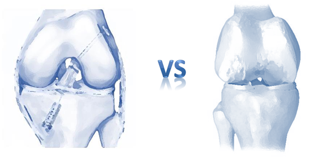 Thoái hóa khớp sau chấn thương: Triệu chứng và cách điều trị