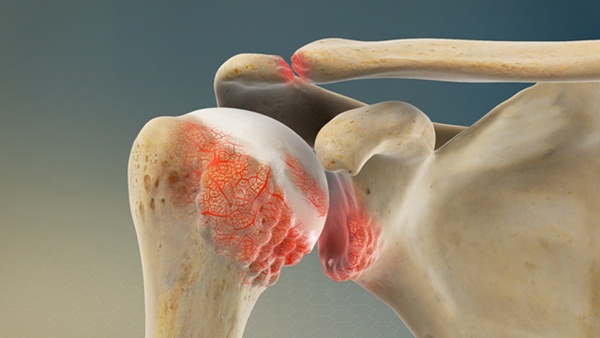 Thoái hóa khớp vai: Triệu chứng và cách điều trị