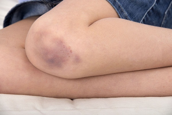 Các triệu chứng ít gặp của bệnh viêm khớp dạng thấp