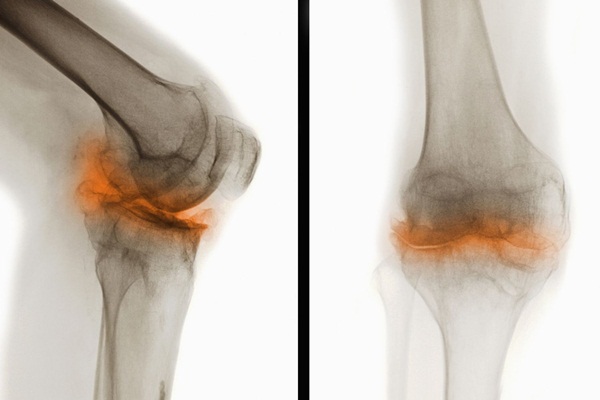 Chụp X-quang có phát hiện được thoái hóa khớp háng không?