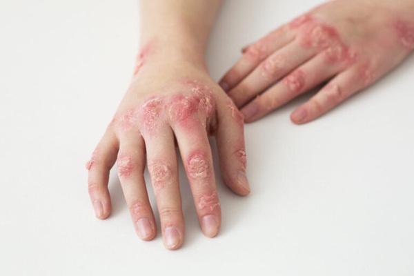 Viêm khớp vảy nến: Nguyên nhân, triệu chứng và điều trị