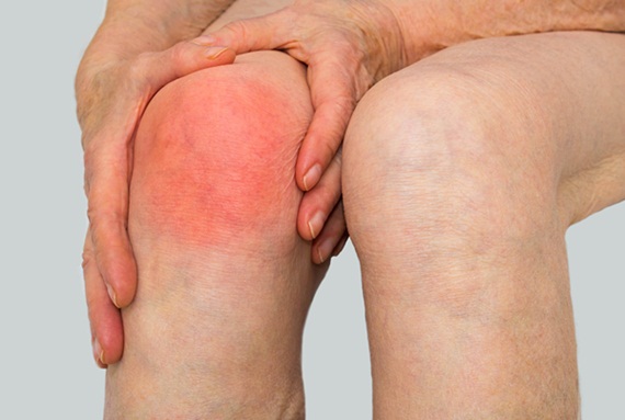 Viêm khớp do virus: Triệu chứng và cách điều trị