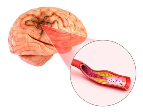 Đột quỵ do huyết khối là gì?