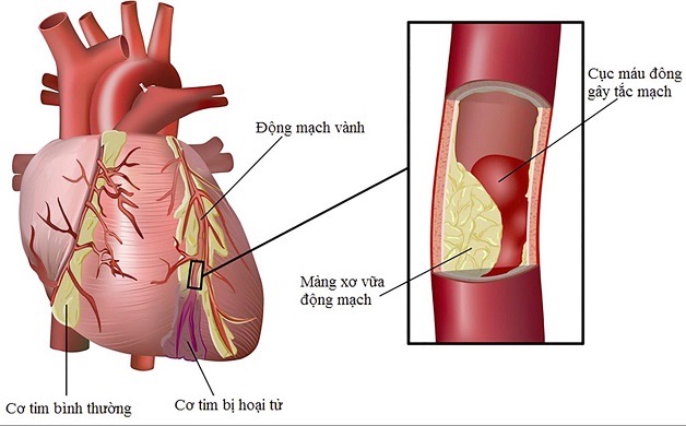 Bệnh động mạch vành (CAD) và Hội chứng mạch vành cấp (ACS)