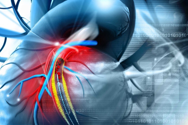 Bệnh tiểu đường và bệnh động mạch vành có mối liên hệ như thế nào?