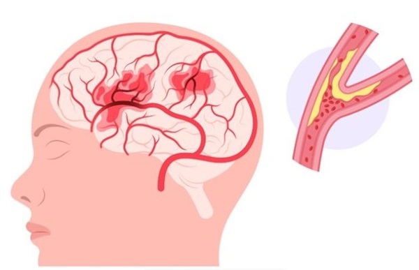 Triệu chứng của cơn thiếu máu não thoáng qua