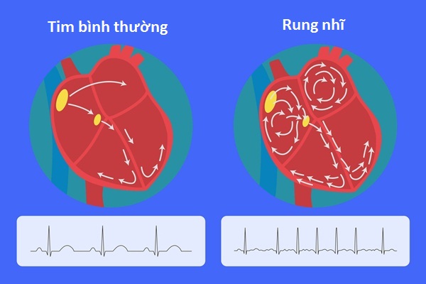 Rối loạn nhịp tim có thể làm tăng nguy cơ đột quỵ