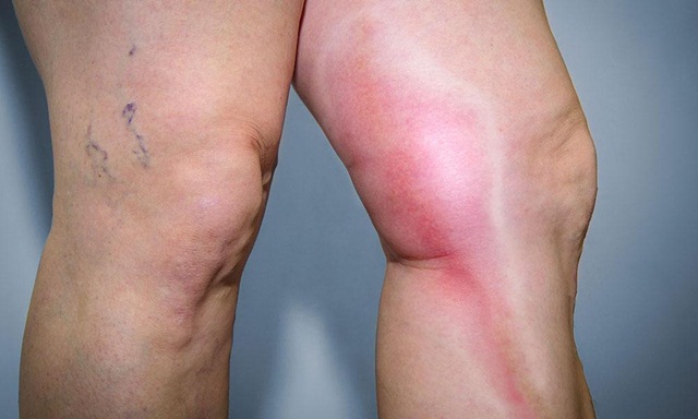 Viêm tĩnh mạch huyết khối: Triệu chứng và cách điều trị