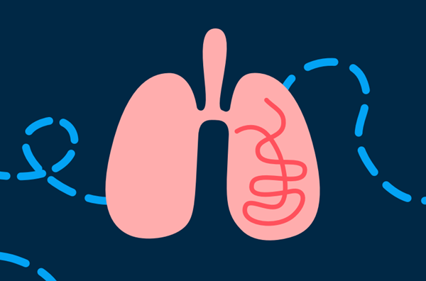 Căng thẳng ảnh hưởng như thế nào đến bệnh phổi tắc nghẽn mạn tính (COPD)?