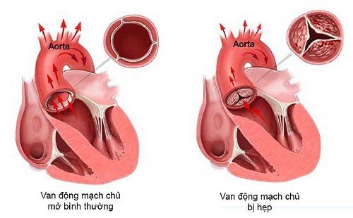 Điều trị hẹp van động mạch chủ không cần phẫu thuật