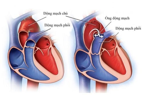 Thủ thuật thay van động mạch chủ qua ống thông (TAVR) là gì?