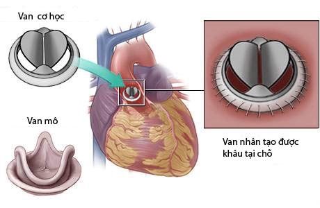 Những điều cần biết về phẫu thuật thay van hai lá