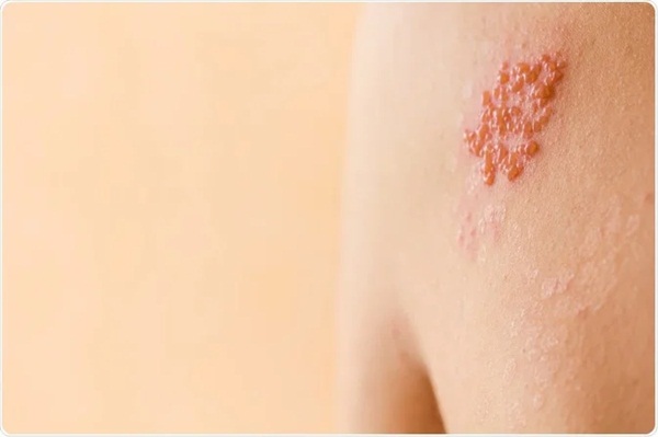 Căng thẳng có thể gây ra bệnh zona thần kinh không?