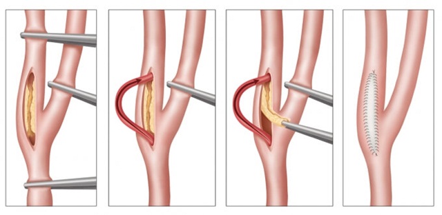 Phẫu thuật bóc nội mạc động mạch cảnh