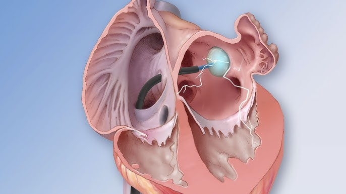 Thủ thuật đốt điện tim có tác dụng gì?