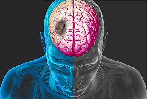 Mối liên hệ giữa rung nhĩ và đột quỵ là gì?