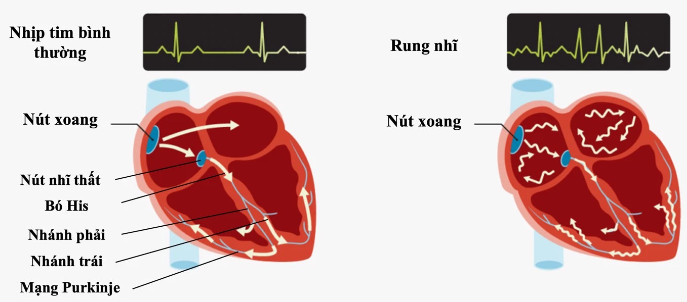 Nguyên nhân gây rung nhĩ sau phẫu thuật bắc cầu động mạch vành và cách điều trị