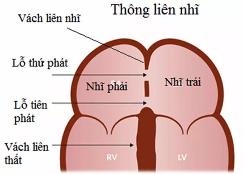 Thông liên nhĩ là gì? Nguyên nhân, triệu chứng và phương pháp điều trị?