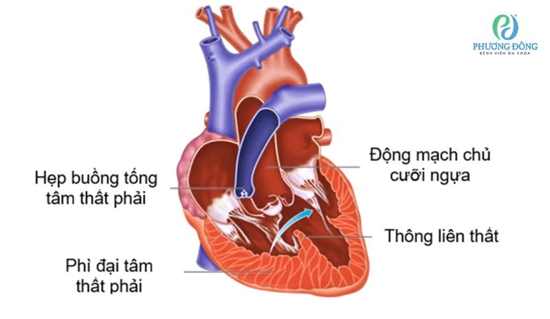 Tứ chứng Fallot: Triệu chứng, nguyên nhân, chẩn đoán và điều trị