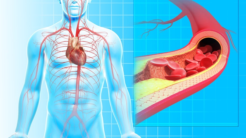 Những điều cần biết về huyết khối động mạch vành