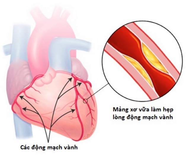 Bệnh mạch vành ba nhánh: Điều trị và tiên lượng