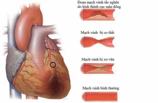 Co thắt động mạch vành: Triệu chứng, chẩn đoán và điều trị
