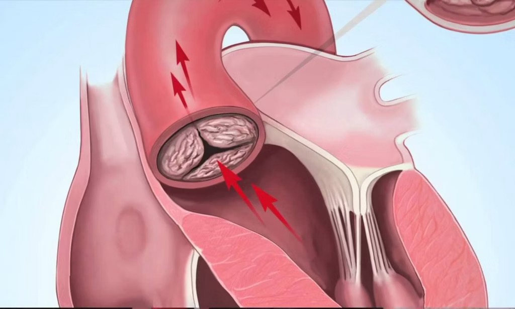 Vôi hóa mạch vành: Nguyên nhân, triệu chứng, chẩn đoán và điều trị