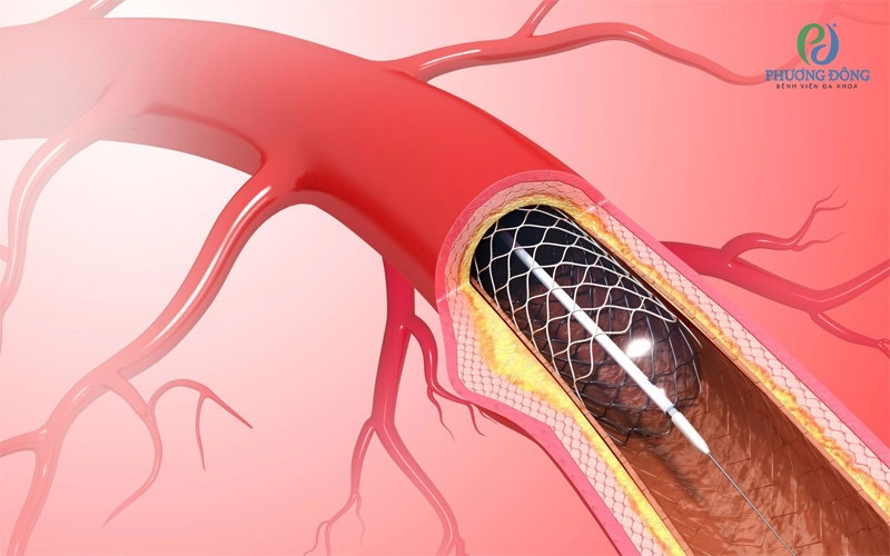 Can thiệp động mạch vành qua da (PCI) trong điều trị bệnh động mạch vành