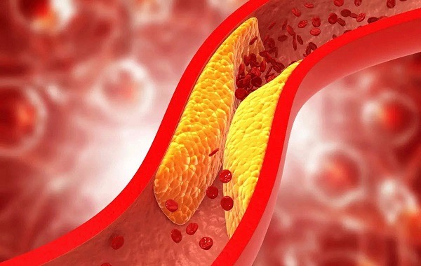 Xơ vữa động mạch là gì? Phương pháp điều trị xơ vữa động mạch?