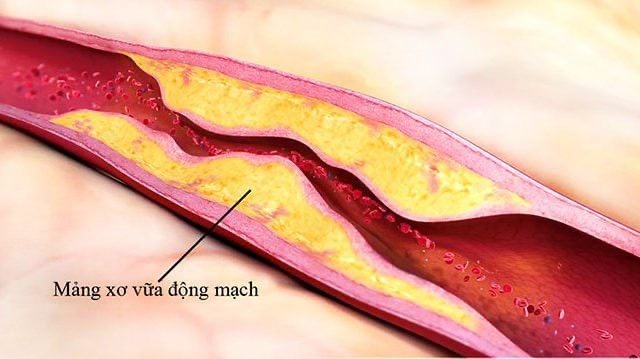 Sự khác biệt giữa xơ vữa động mạch và xơ cứng động mạch