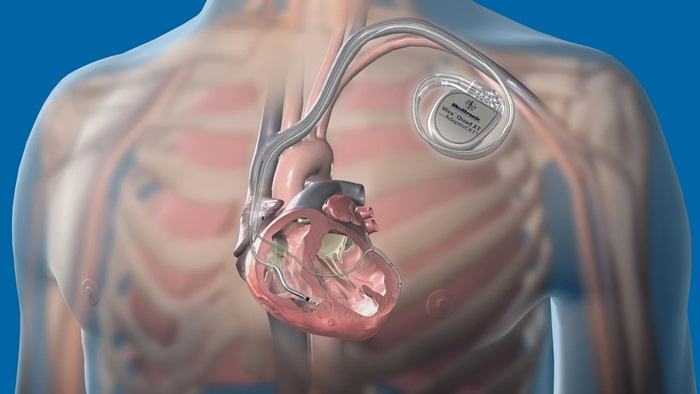 Máy khử rung tim cấy ghép (ICD) có tác dụng gì?