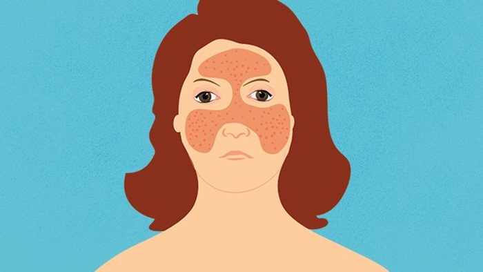 Ảnh hưởng của bệnh lupus đến nhịp tim