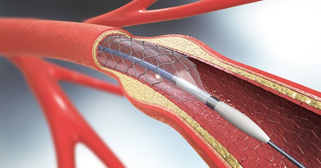 Đặt stent động mạch cảnh có tác dụng gì? Cần thực hiện khi nào?