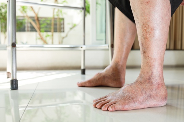 Điều trị triệu chứng của bệnh động mạch ngoại biên
