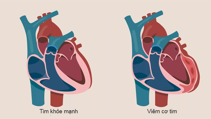 Viêm cơ tim: Nguyên nhân, triệu chứng và cách điều trị