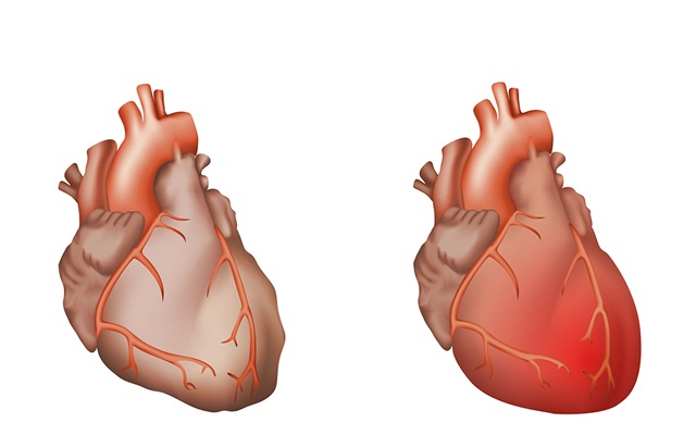 Viêm màng ngoài tim do vi khuẩn: Triệu chứng và cách điều trị