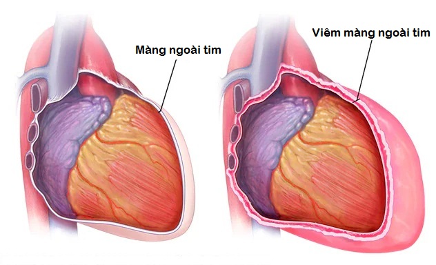 Viêm màng ngoài tim: Nguyên nhân, triệu chứng và cách điều trị