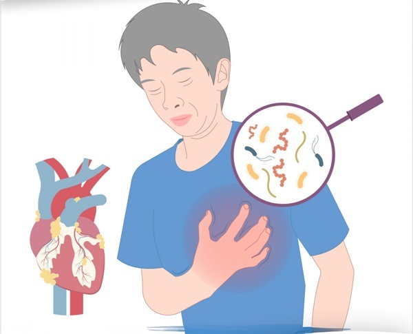 Viêm nội tâm mạc nhiễm khuẩn bán cấp là gì?