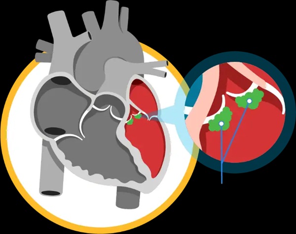 Viêm nội tâm mạc nhiễm trùng: Triệu chứng và phương pháp điều trị