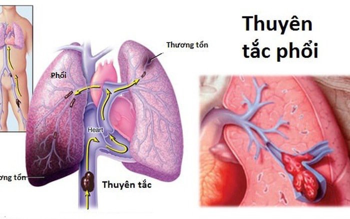 Những điều cần biết về thuyên tắc phổi